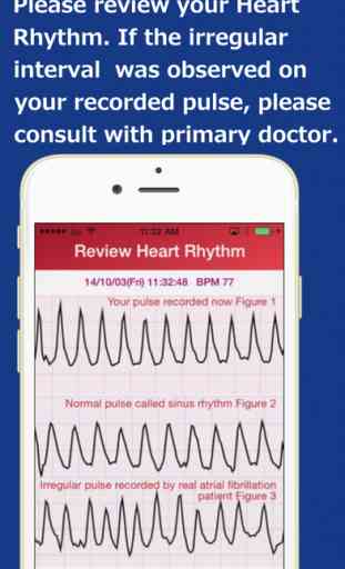Heart_Rhythm   Heart Rhythm App finds risk for onset of Stroke Risk 3
