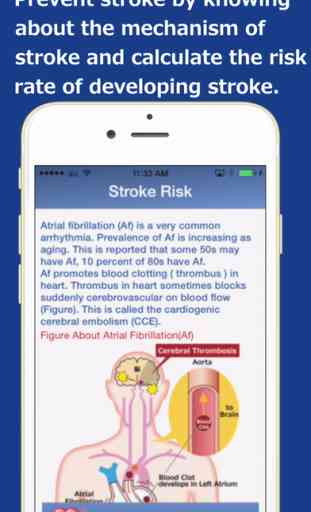 Heart_Rhythm   Heart Rhythm App finds risk for onset of Stroke Risk 4